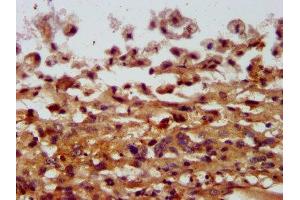 IHC image of ABIN7148018 diluted at 1:400 and staining in paraffin-embedded human melanoma performed on a Leica BondTM system. (COPG2 抗体  (AA 676-823))