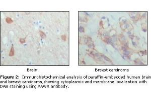 Immunohistochemical analysis of paraffin-embedded human brain (left) and breast carcinoma (right), showing cytoplasmic and membrane localization using PAR4 antibody with DAB staining. (F2RL3 抗体  (AA 1-330))