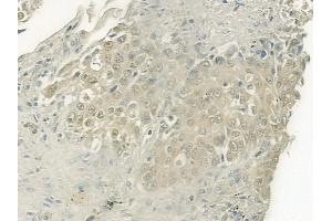 ABIN6264131 and ABIN6277486 at 1/100 staining human lung squamous cell carcinoma by IHC-P. (PELP1 抗体  (Internal Region))