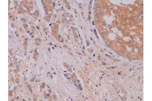 Detection of β-catenin in Human Breast cancer Tissue using Monoclonal Antibody to Beta Catenin (β-catenin) (beta Catenin 抗体  (AA 439-675))