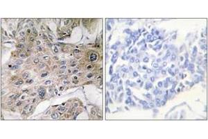 Immunohistochemistry analysis of paraffin-embedded human breast carcinoma tissue, using COX7S/A2 Antibody. (COX7S/A2 (AA 1-50) 抗体)