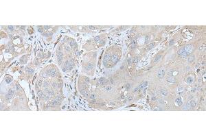 Immunohistochemistry of paraffin-embedded Human esophagus cancer tissue using USO1 Polyclonal Antibody at dilution of 1:30(x200) (USO1 抗体)