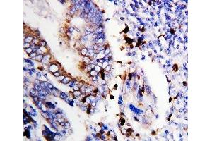 IHC-P: Bcl-XS antibody testing of human colon cancer tissue (Bcl-X/s (AA 120-130) 抗体)