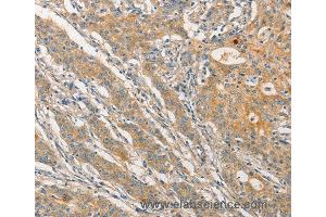 Immunohistochemistry of Human esophagus cancer using STAM Polyclonal Antibody at dilution of 1:40 (STAM 抗体)