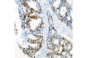 Immunohistochemical analysis of CDK2 staining in human colon cancer formalin fixed paraffin embedded tissue section. (CDK2 抗体  (Center))