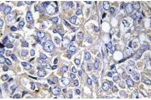 Immunohistochemistry analysis of Cortactin antibody in paraffin-embedded human prostate carcinoma tissue. (Cortactin 抗体  (pTyr421))