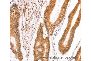 Immunohistochemistry of Human thyroid cancer using TAX1BP1 Polyclonal Antibody at dilution of 1:40 (TAX1BP1 抗体)
