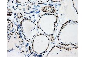 Immunohistochemical staining of paraffin-embedded Adenocarcinoma of colon tissue using anti-RALBP1mouse monoclonal antibody. (RALBP1 抗体)