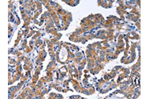 The image on the left is immunohistochemistry of paraffin-embedded Human thyroid cancer tissue using ABIN7129821(IGSF10 Antibody) at dilution 1/50, on the right is treated with fusion protein. (IGSF1 抗体)