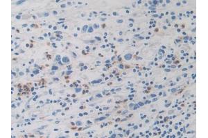 DAB staining on IHC-P; Samples: Human Stomach cancer Tissue (Dopamine Receptor d1 抗体  (AA 338-446))