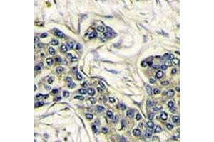 IHC analysis of FFPE human breast carcinoma stained with PI3KCA antibody (PIK3CA 抗体  (AA 504-533))