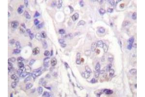 Immunohistochemical analysis of human breast carcinoma tissue (Formalin- fixed Paraffin-embedded) using CDC16 / APC6 antibody . (CDC16 抗体)