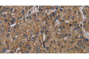 Immunohistochemistry of paraffin-embedded Human liver cancer tissue using NDUFS6 Polyclonal Antibody at dilution 1:50 (NDUFS6 抗体)