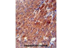 CES2 antibody (Center) immunohistochemistry analysis in formalin fixed and paraffin embedded human hepatocarcinoma followed by peroxidase conjugation of the secondary antibody and DAB staining. (CES2 抗体  (Middle Region))