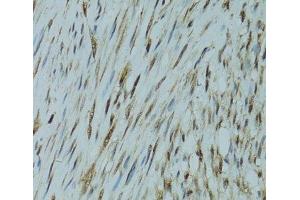 Immunohistochemistry of paraffin-embedded Human uterine cancer using GABPA Polyclonal Antibody at dilution of 1:100 (40x lens). (GABPA 抗体)