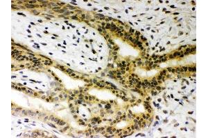 Anti-SIRT6Picoband antibody, (ABIN3043435), IHC(P)IHC(P): Human Mammary Cancer Tissue (SIRT6 抗体  (AA 14-180))