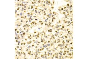 Immunohistochemistry of paraffin-embedded human kidney cancer using HDGF Antibody. (HDGF 抗体  (AA 1-240))