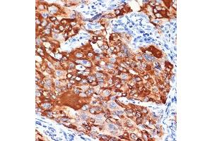 Immunohistochemistry of paraffin-embedded human lung cancer using IL13R Rabbit mAb (ABIN7267986) at dilution of 1:100 (40x lens). (IL13 Receptor alpha 1 抗体)