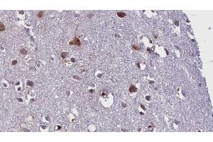 ABIN6275839 at 1/100 staining Human brain cancer tissue by IHC-P. (MATK 抗体  (Internal Region))