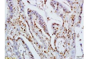 Formalin-fixed and paraffin embedded human colon carcinoma labeled with Rabbit Anti KLF4 Polyclonal Antibody, Unconjugated  at 1:200 followed by conjugation to the secondary antibody and DAB staining (KLF2/4 抗体  (AA 415-513))