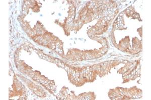 Formalin-fixed, paraffin-embedded human Prostate Carcinoma stained with CD47 Mouse Monoclonal Antibody (IAP/3019).
