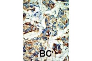 Formalin-fixed and paraffin-embedded human cancer tissue reacted with the primary antibody, which was peroxidase-conjugated to the secondary antibody, followed by AEC staining. (NEK4 抗体  (C-Term))