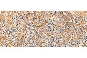 Immunohistochemistry of paraffin-embedded Human liver cancer tissue using DNAJC14 Polyclonal Antibody at dilution of 1:70(x200) (DNAJC14 抗体)
