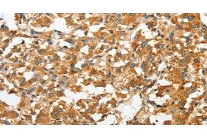 Immunohistochemistry of paraffin-embedded Human thyroid cancer tissue using ANXA9 Polyclonal Antibody at dilution 1:30 (Annexin A9 抗体)
