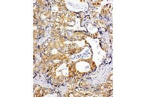 Anti-SDHC antibody, IHC(P) IHC(P): Human Gastric Cancer Tissue (SDHC 抗体  (N-Term))