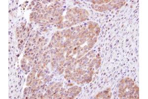 IHC-P Image Immunohistochemical analysis of paraffin-embedded NCIN87 xenograft, using CHMP5, antibody at 1:100 dilution. (CHMP5 抗体)