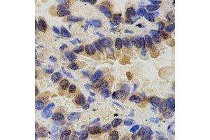 Immunohistochemical analysis of PAK2 staining in human lung cancer formalin fixed paraffin embedded tissue section.