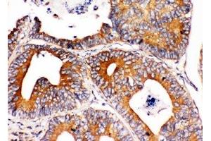 IHC-P: Integrin alpha 1 antibody testing of human intestinal cancer tissue (Integrin alpha 1 抗体  (C-Term))