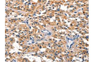 The image on the left is immunohistochemistry of paraffin-embedded Human thyroid cancer tissue using ABIN7190518(DUSP2 Antibody) at dilution 1/30, on the right is treated with synthetic peptide. (DUSP2 抗体)
