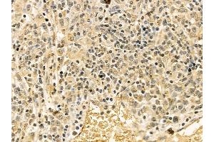 FAK Mouse Monoclonal Antibody at 1/100 staining human gastric cancer by IHC-P. (FAK 抗体  (Internal Region))