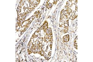 Immunohistochemistry of paraffin-embedded human lung cancer using UQCRH Rabbit mAb (ABIN7271126) at dilution of 1:50 (40x lens). (UQCRH 抗体)