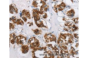 Immunohistochemistry of Human thyroid cancer using HINT2 Polyclonal Antibody at dilution of 1:50 (HINT2 抗体)