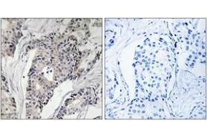 Immunohistochemistry analysis of paraffin-embedded human breast carcinoma, using THBS4 Antibody. (THBS4 抗体  (AA 561-610))