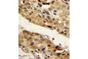 Formalin-fixed and paraffin-embedded human hepatocarcinoma reacted with SERPINF1 Antibody (N-term), which was peroxidase-conjugated to the secondary antibody, followed by DAB staining. (PEDF 抗体  (N-Term))