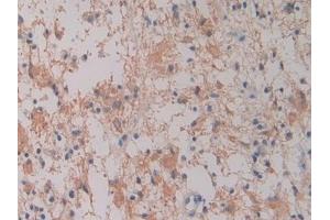 Detection of Hepc in Human Glioma Tissue using Monoclonal Antibody to Hepcidin (Hepc) (Hepcidin 抗体  (AA 25-84))