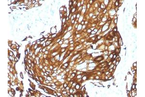 Formalin-fixed, paraffin-embedded human Lung Carcinoma stained with CK LMW Rabbit Recombinant Monoclonal Antibody (KRTL/1577R). (Recombinant Keratin 77 抗体)