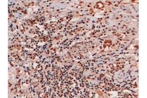 Detection of Ub in Human Endometrial cancer Tissue using Monoclonal Antibody to Ubiquitin (Ub)