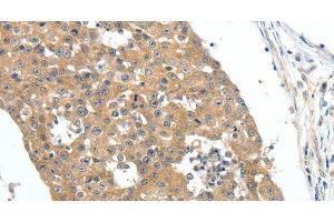 Immunohistochemistry of paraffin-embedded Human breast cancer tissue using FSHR Polyclonal Antibody at dilution 1:70 (FSHR 抗体)