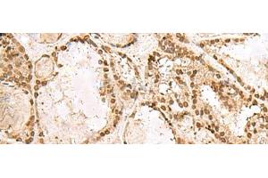 Immunohistochemistry of paraffin-embedded Human thyroid cancer tissue using KRR1 Polyclonal Antibody at dilution of 1:50(x200) (KRR1 抗体)
