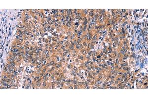 Immunohistochemistry of paraffin-embedded Human cervical cancer tissue using EDN1 Polyclonal Antibody at dilution 1:50 (Endothelin 1 抗体)