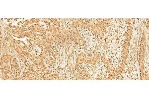Immunohistochemistry of paraffin-embedded Human ovarian cancer tissue using ZNF471 Polyclonal Antibody at dilution of 1:50(x200) (ZNF471 抗体)