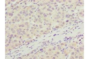 Immunohistochemistry of paraffin-embedded human liver cancer using ABIN7166405 at dilution of 1:100 (ARMT1 (AA 2-250) 抗体)