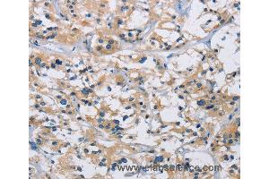 Immunohistochemistry of Human thyroid cancer using IL17RB Polyclonal Antibody at dilution of 1:40 (IL17 Receptor B 抗体)