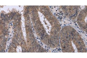 Immunohistochemistry of paraffin-embedded Human colon cancer using CDK5 Polyclonal Antibody at dilution of 1:30 (CDK5 抗体)