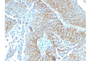 Formalin-fixed, paraffin-embedded human Esophageal carcinoma stained with TRIM29 Mouse Monoclonal Antibody (TRIM29/1041). (TRIM29 抗体  (AA 1-200))