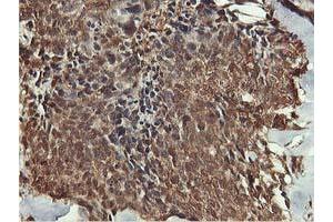 Immunohistochemical staining of paraffin-embedded Adenocarcinoma of Human breast tissue using anti-AKT1 mouse monoclonal antibody. (AKT1 抗体)